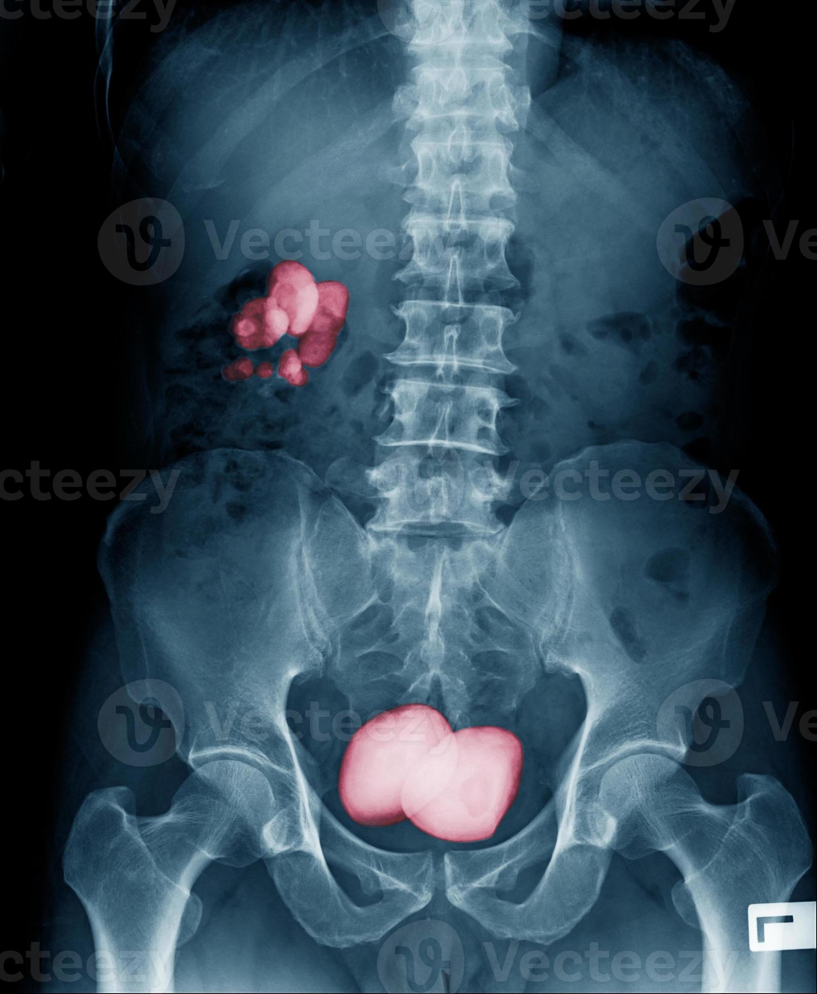 Renal calculus or kidney stone xray image in blue tone 6970396 Stock