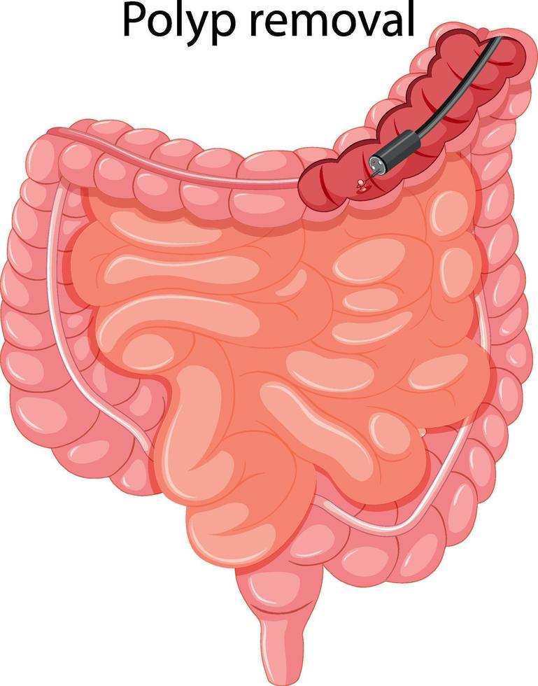 Diagram showing polyp removal vector