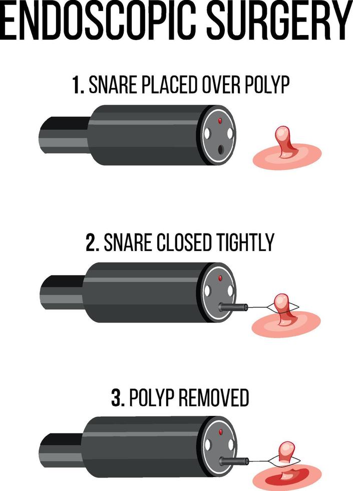 Diagram showing endoscopic surgery vector