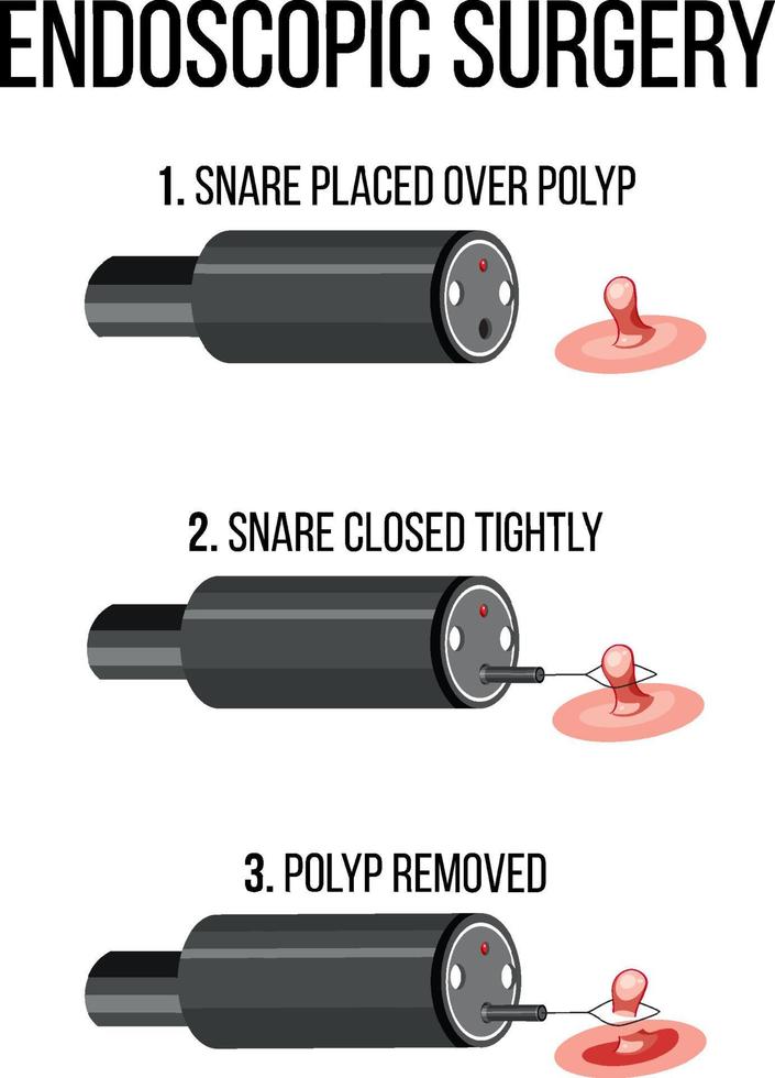 diagrama que muestra la cirugía endoscópica vector