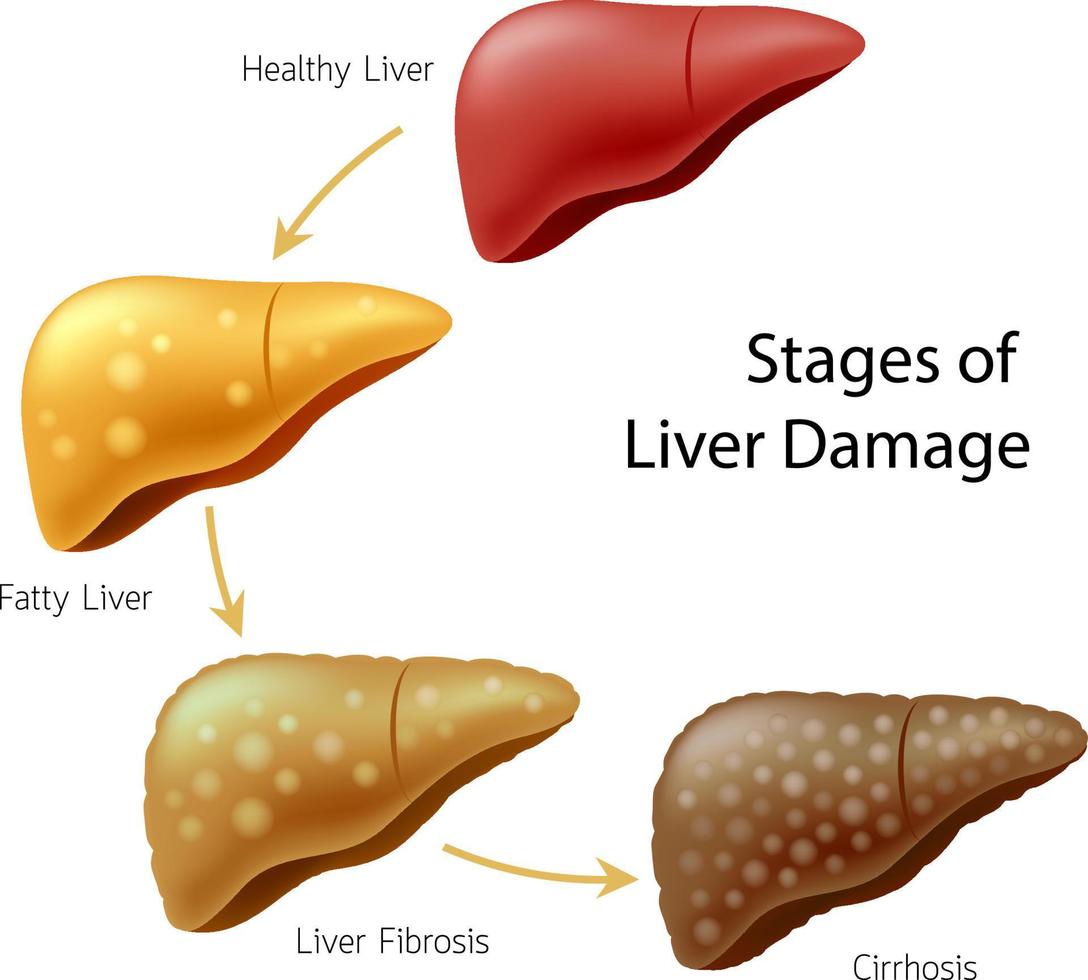 Stages of liver damage. vector