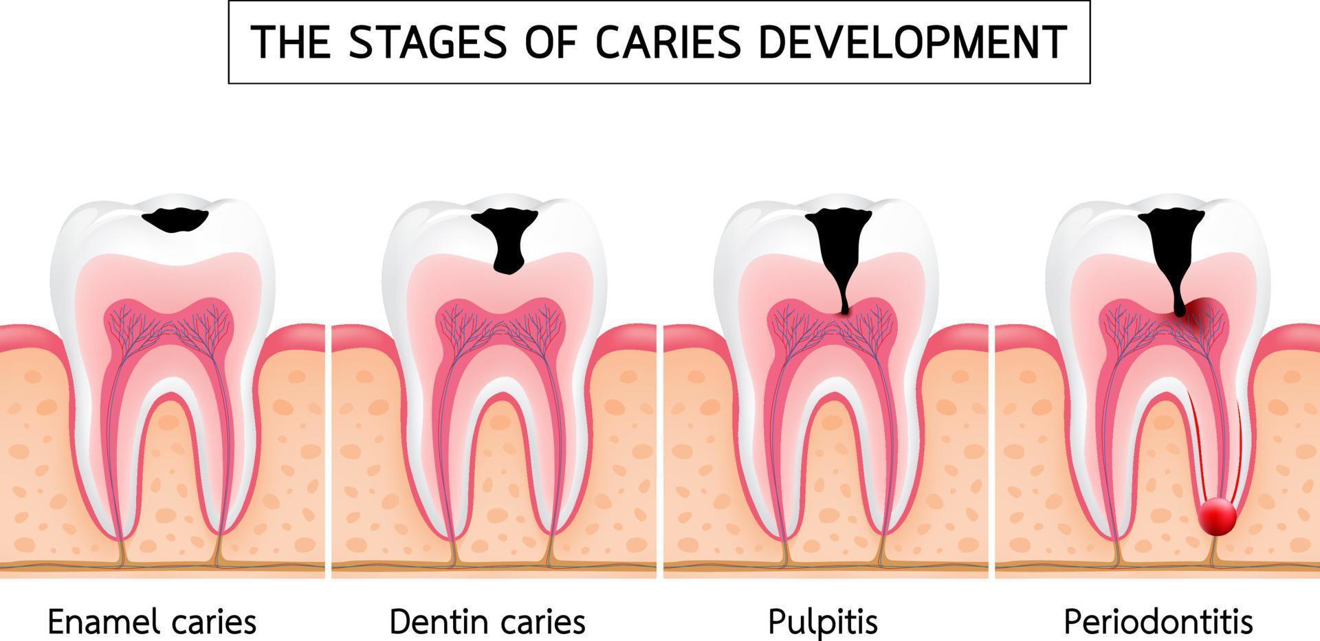 Stages of caries development vector