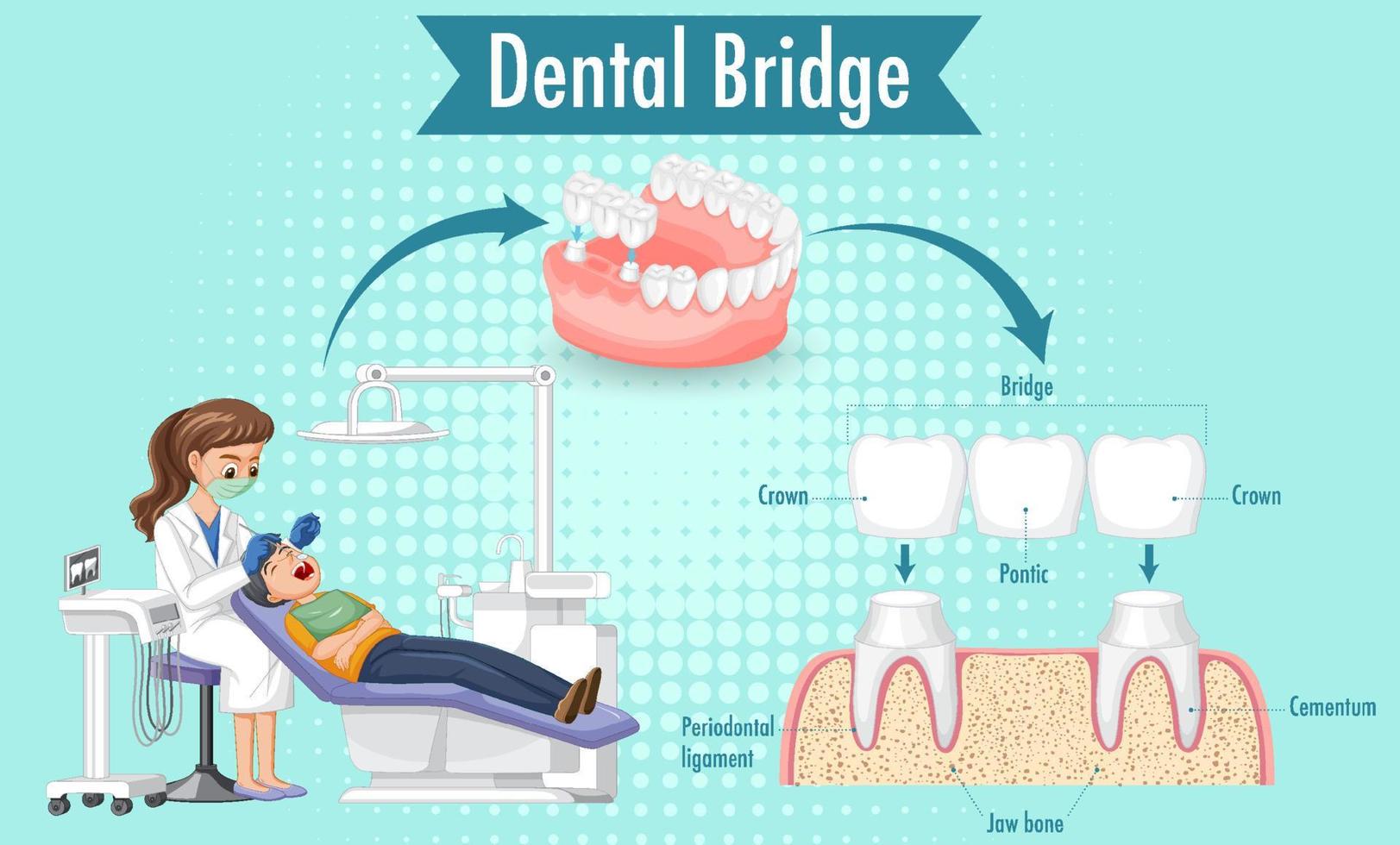 Infographic of human in dental bridge vector