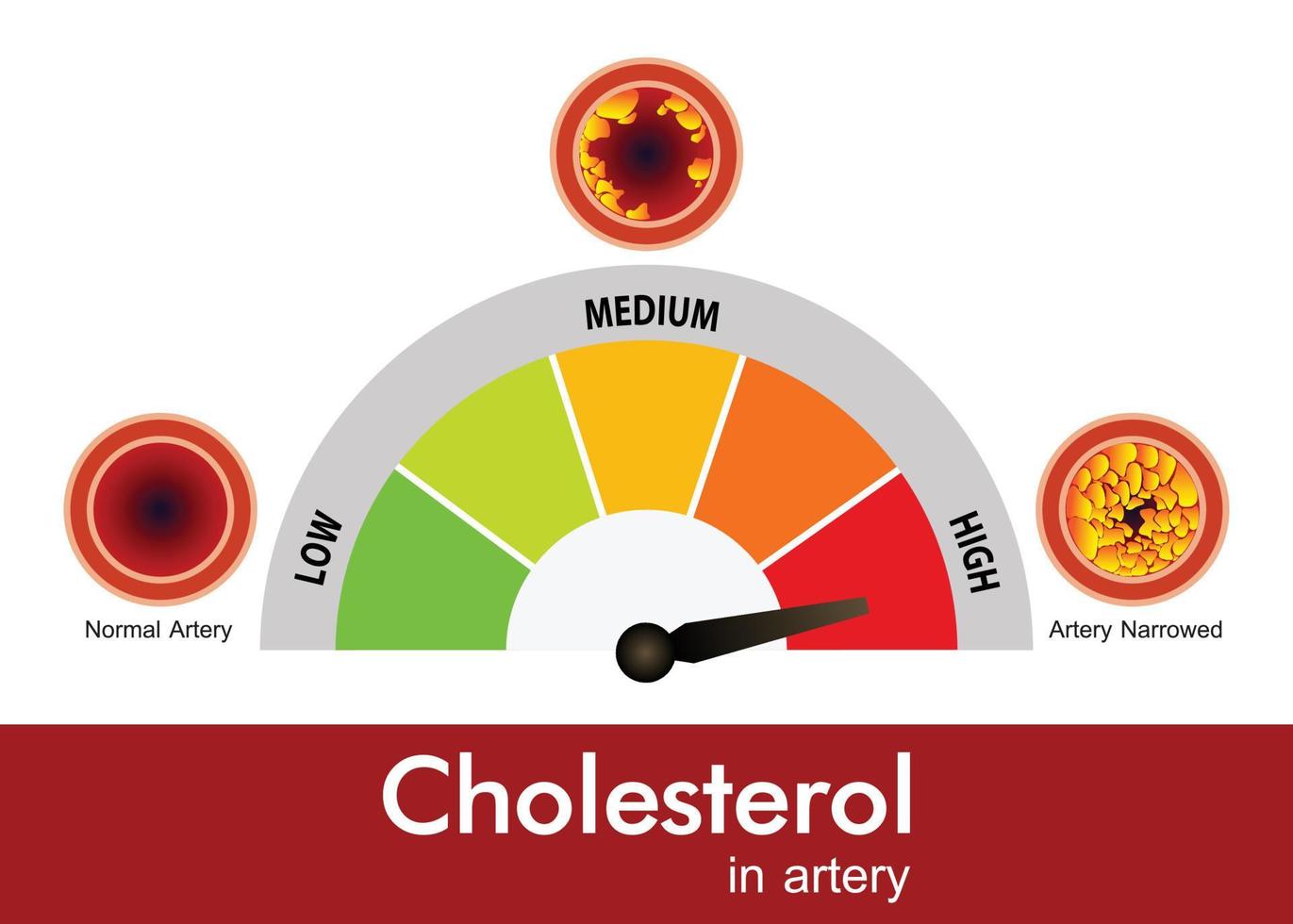 Cholesterol in artery, health risk , vector design