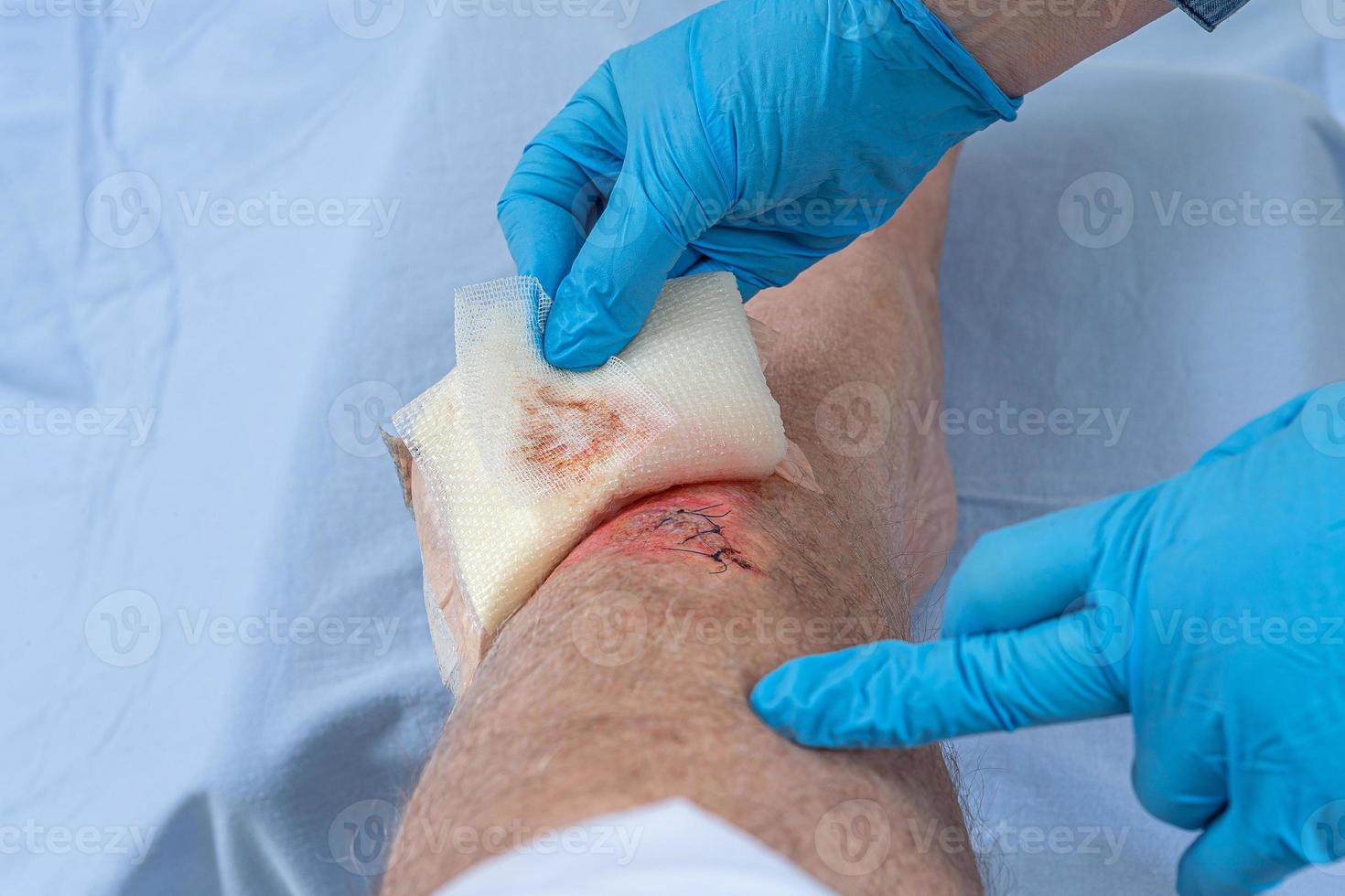 Nurse caring fresh blooded injury wound on the tibial bone of the leg. Sticking stitches to hold the cut. photo