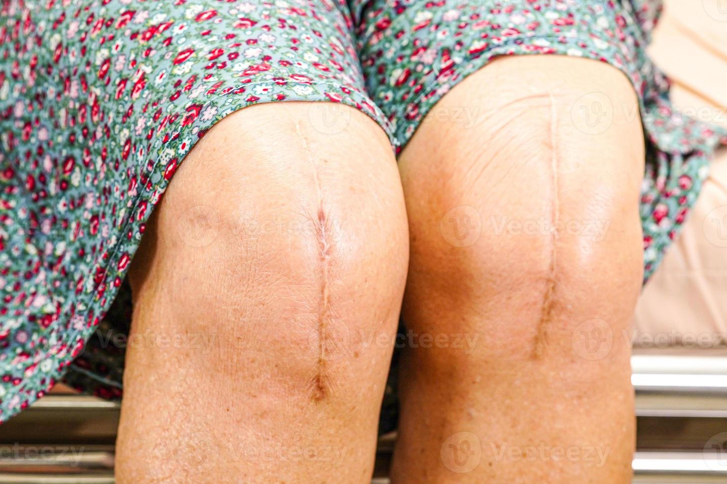 Paciente anciana asiática con cirugía de reemplazo de rodilla con cicatriz en el hospital. foto