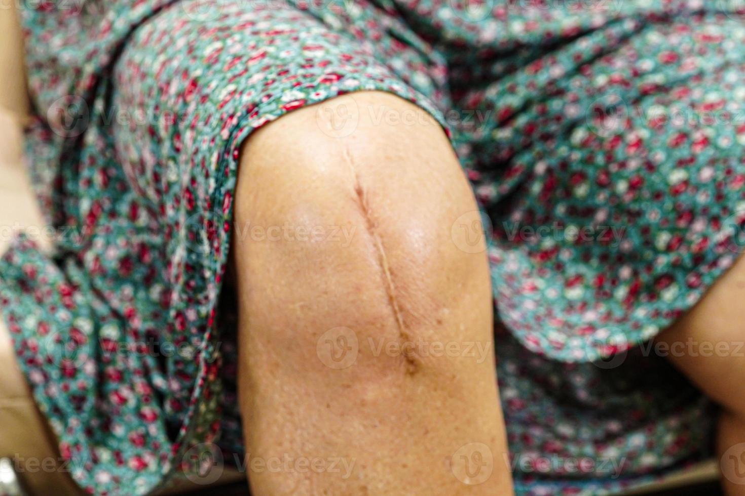 Asian elderly woman patient with scar knee replacement surgery in hospital. photo