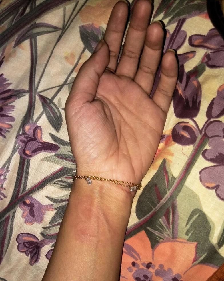 hand with bracelet and dermatographia photo