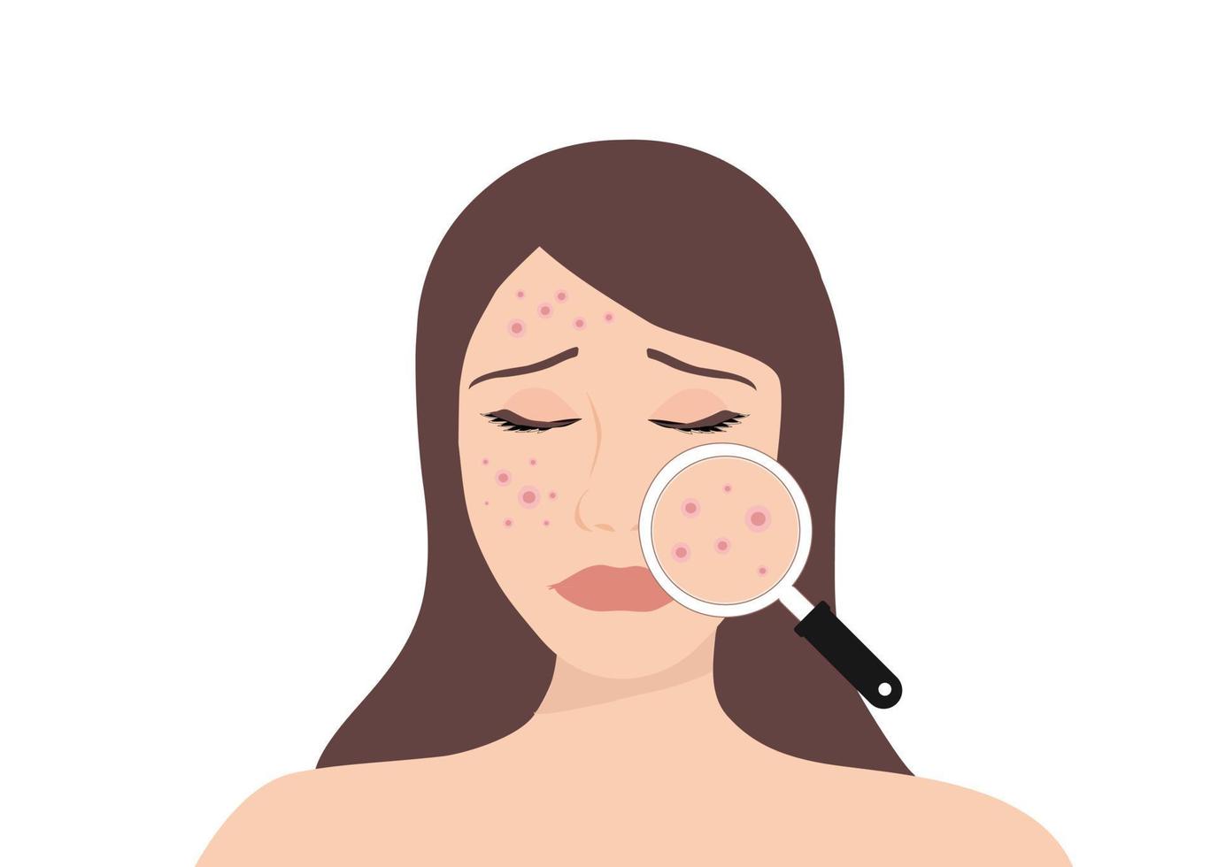 Young woman face with skin acne, pimples, blackheads vector illustration. Acne skin face problem concept