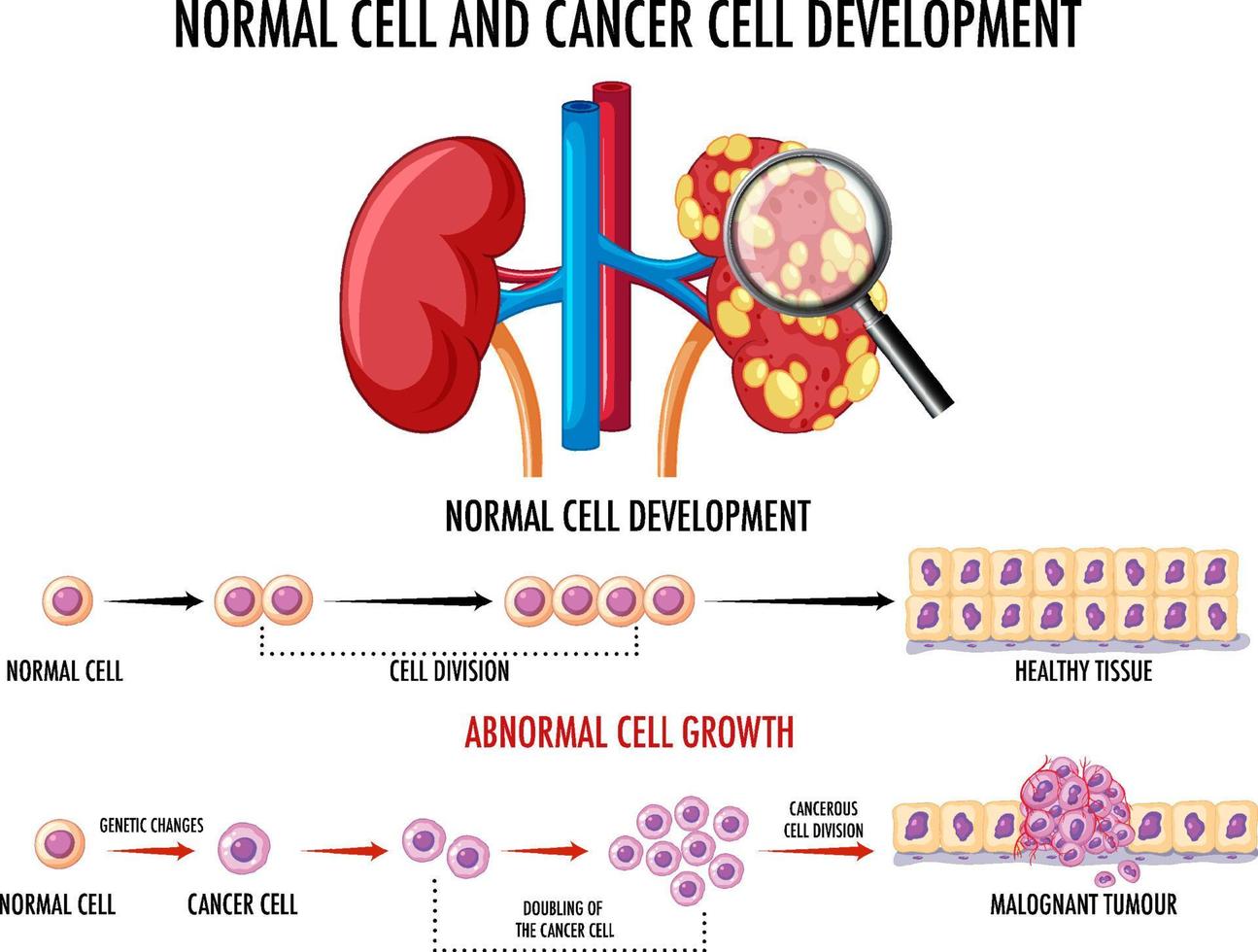 diagrama que muestra el proceso de desarrollo del cáncer vector