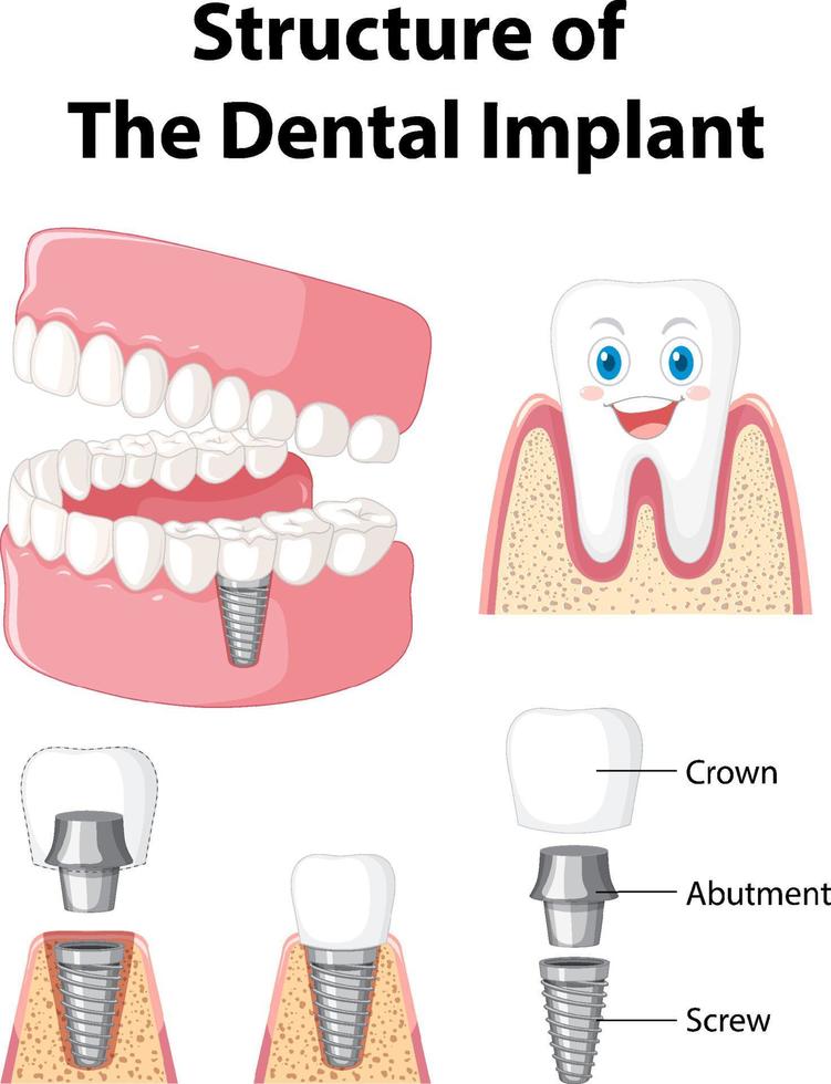 infografía de humanos en la estructura del implante dental. vector