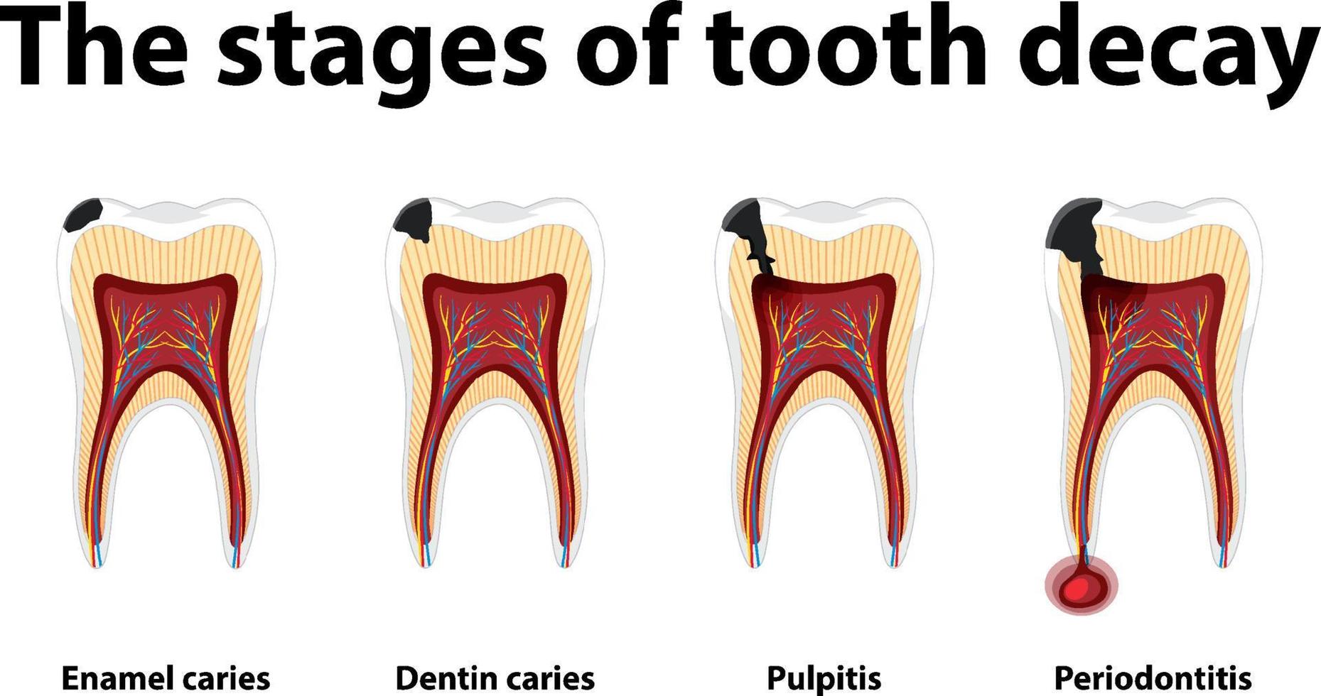 infografía de humanos en las etapas de la caries dental vector