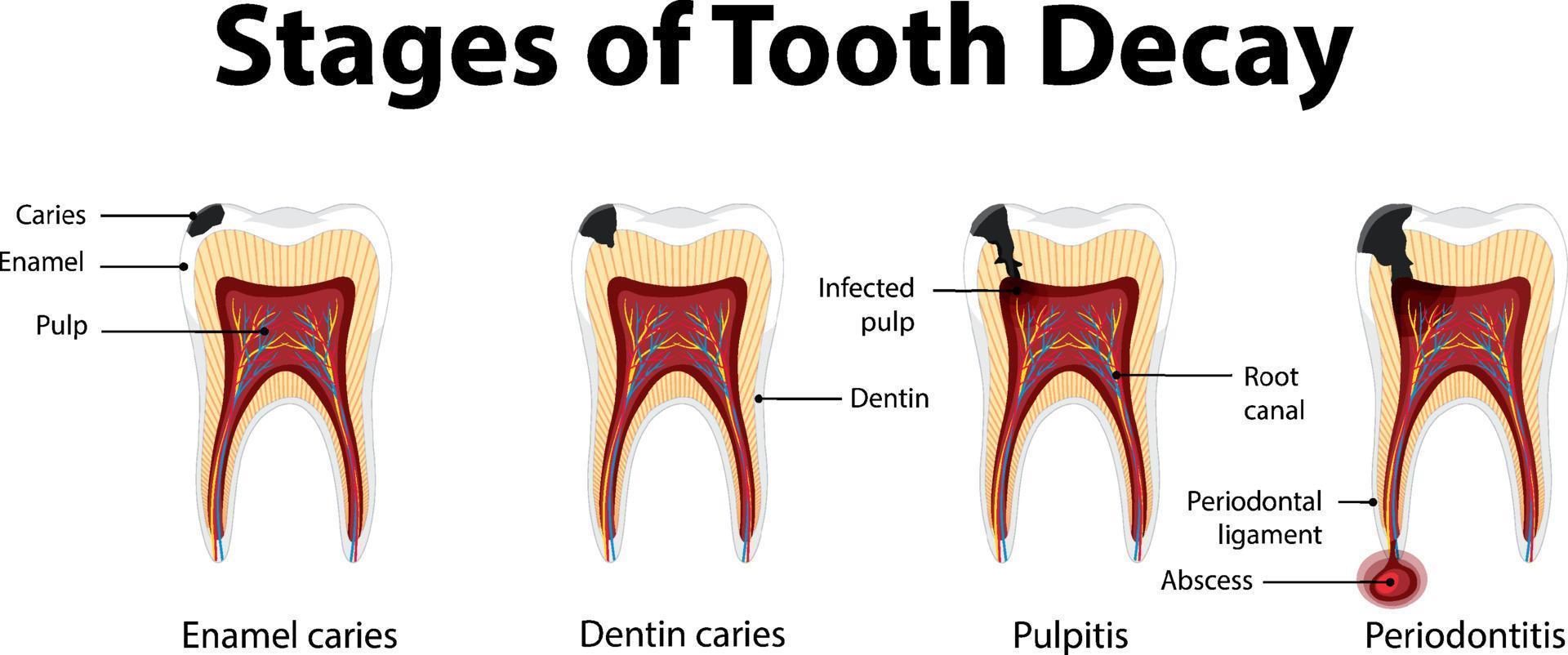 Infographic of human in the stages of tooth decay vector