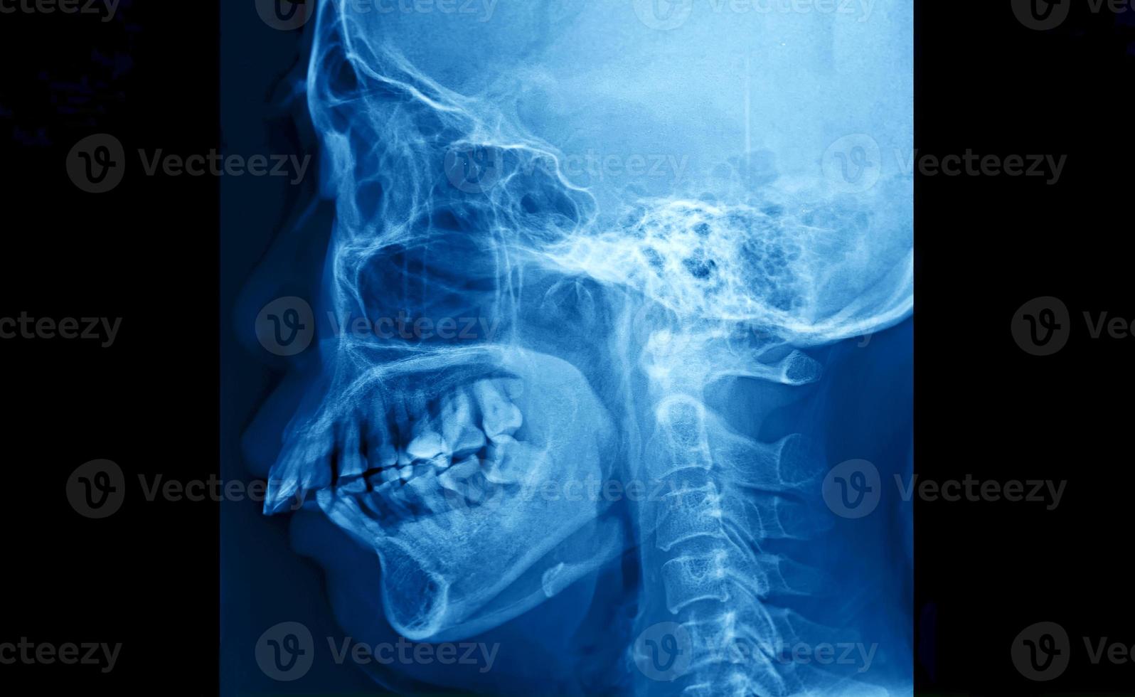 película de rayos X del cráneo y vista lateral de la columna cervical para el concepto médico. foto