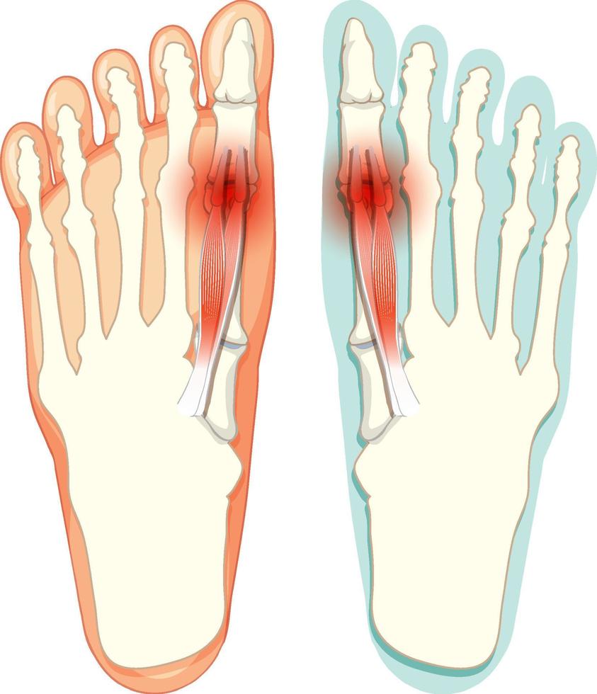 Hallux valgus types on white background vector