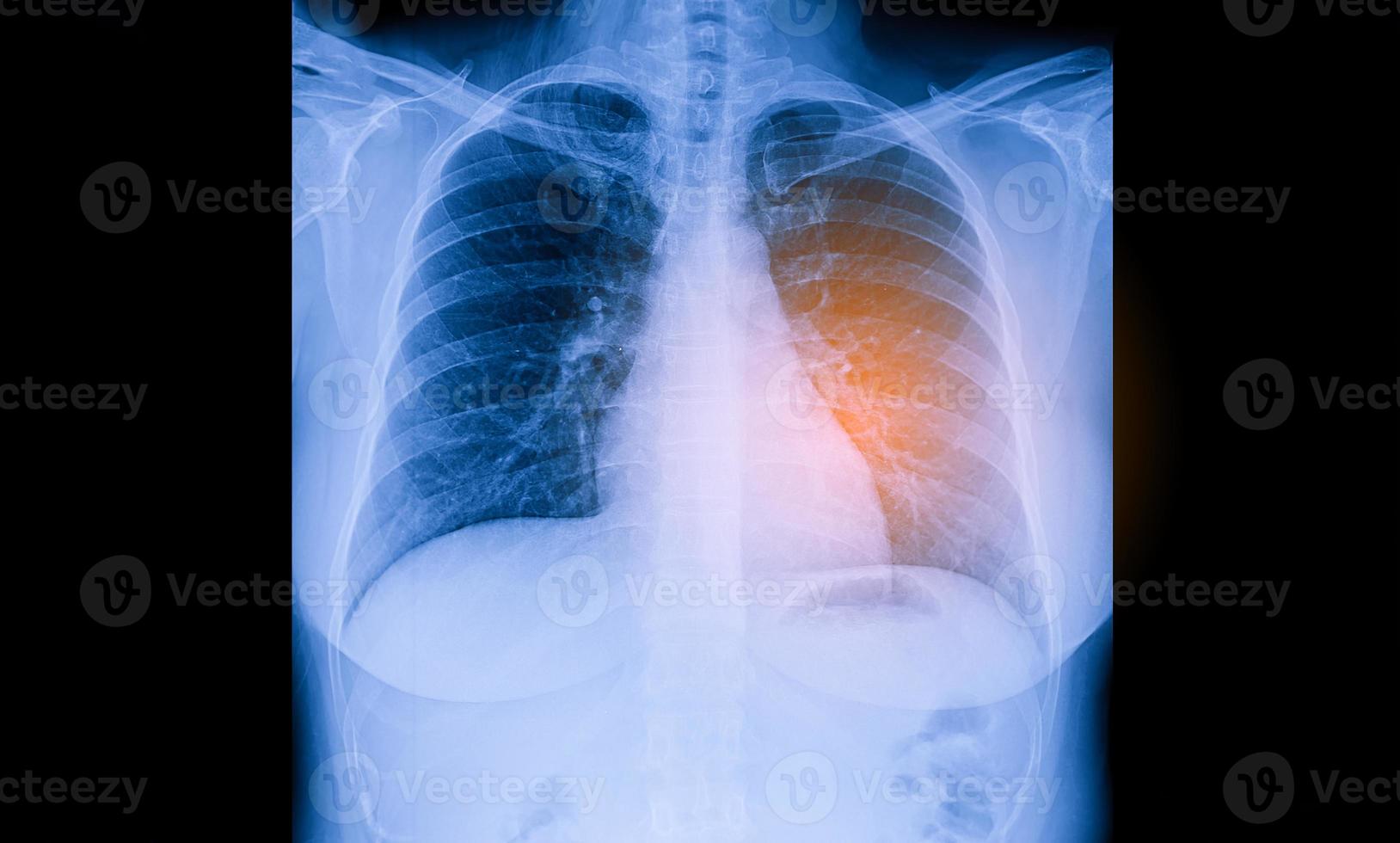 Insuficiencia cardíaca, radiografía de tórax en posición vertical muestra cardiomegalia e infiltrado intersticial ambos foto