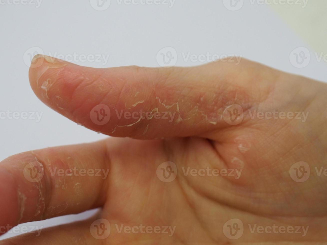 a peeling hand skin on white background photo