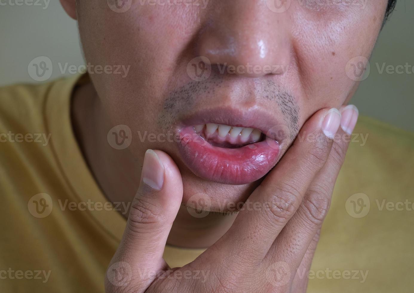 cerrar el labio del hombre tiene una úlcera en la boca. estomatitis en el labio. concepto de problema de salud. foto