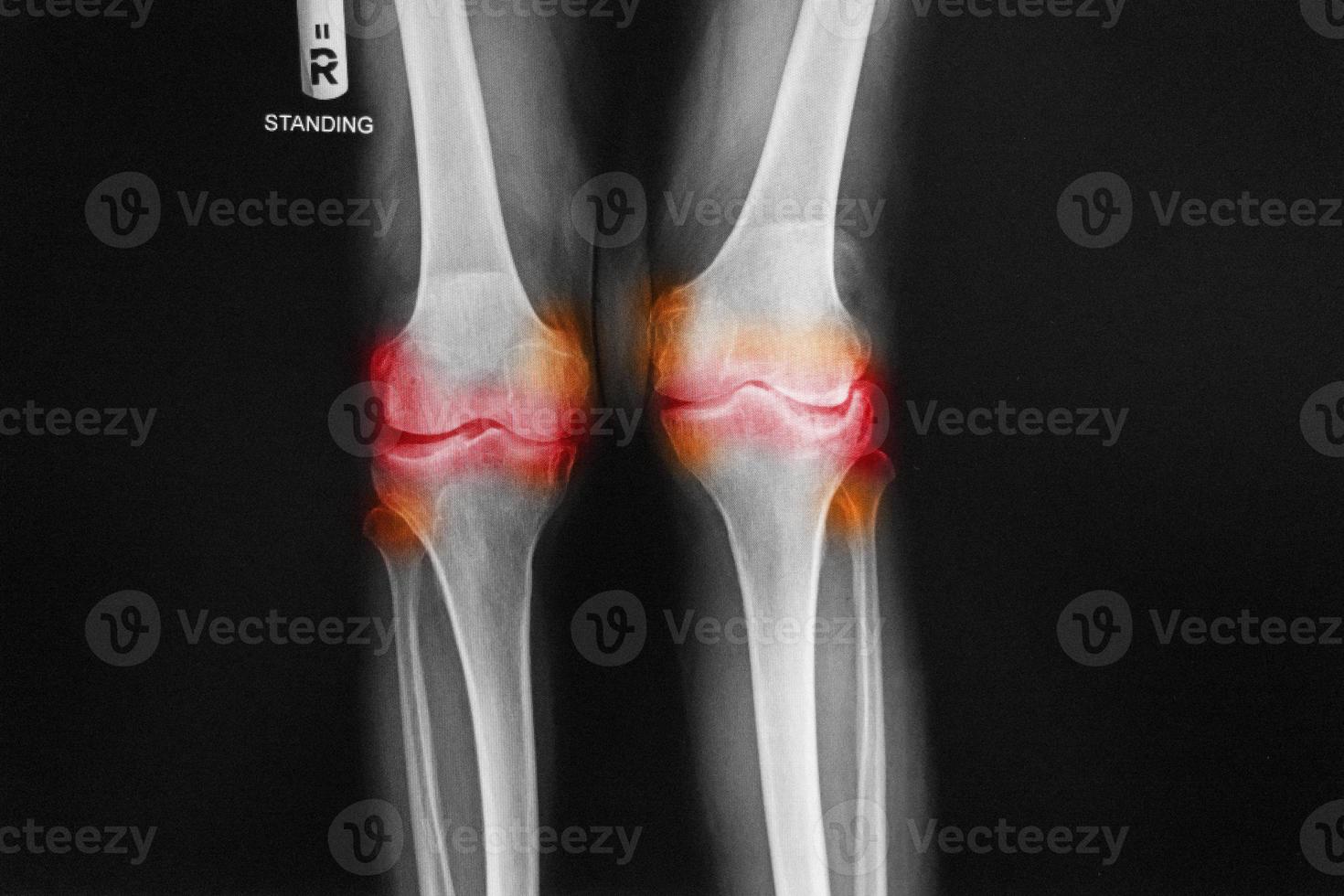 osteoartritis radiografía de la rodilla derecha ap anterior - posterior de la rodilla muestra un espacio articular estrecho. foto