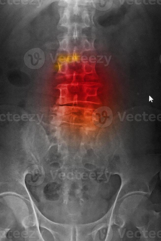 Computed radiography CR of lumbosarcal spine anteroposteriorAP showing spondylosis and scoliosis spine. photo