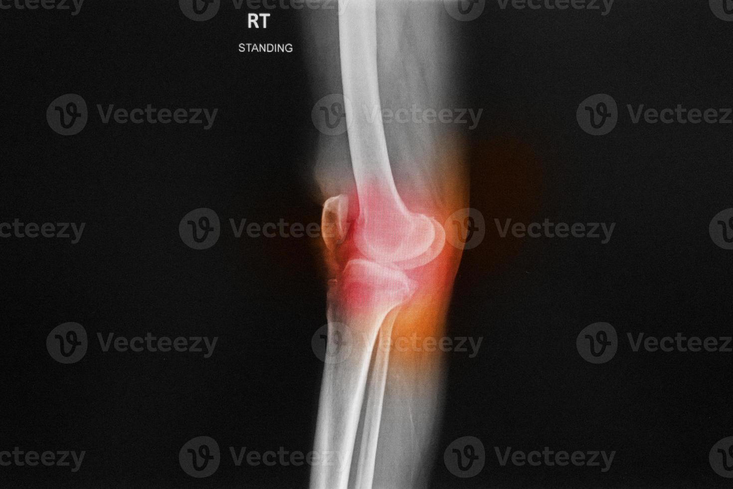 XRay Right knee joint show narrow space. photo