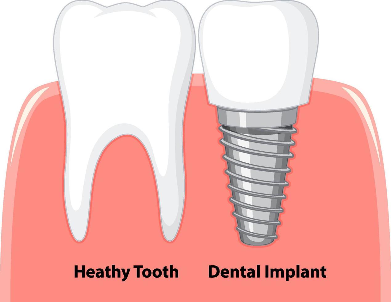 diente saludable e implante dental en la encía sobre fondo blanco vector