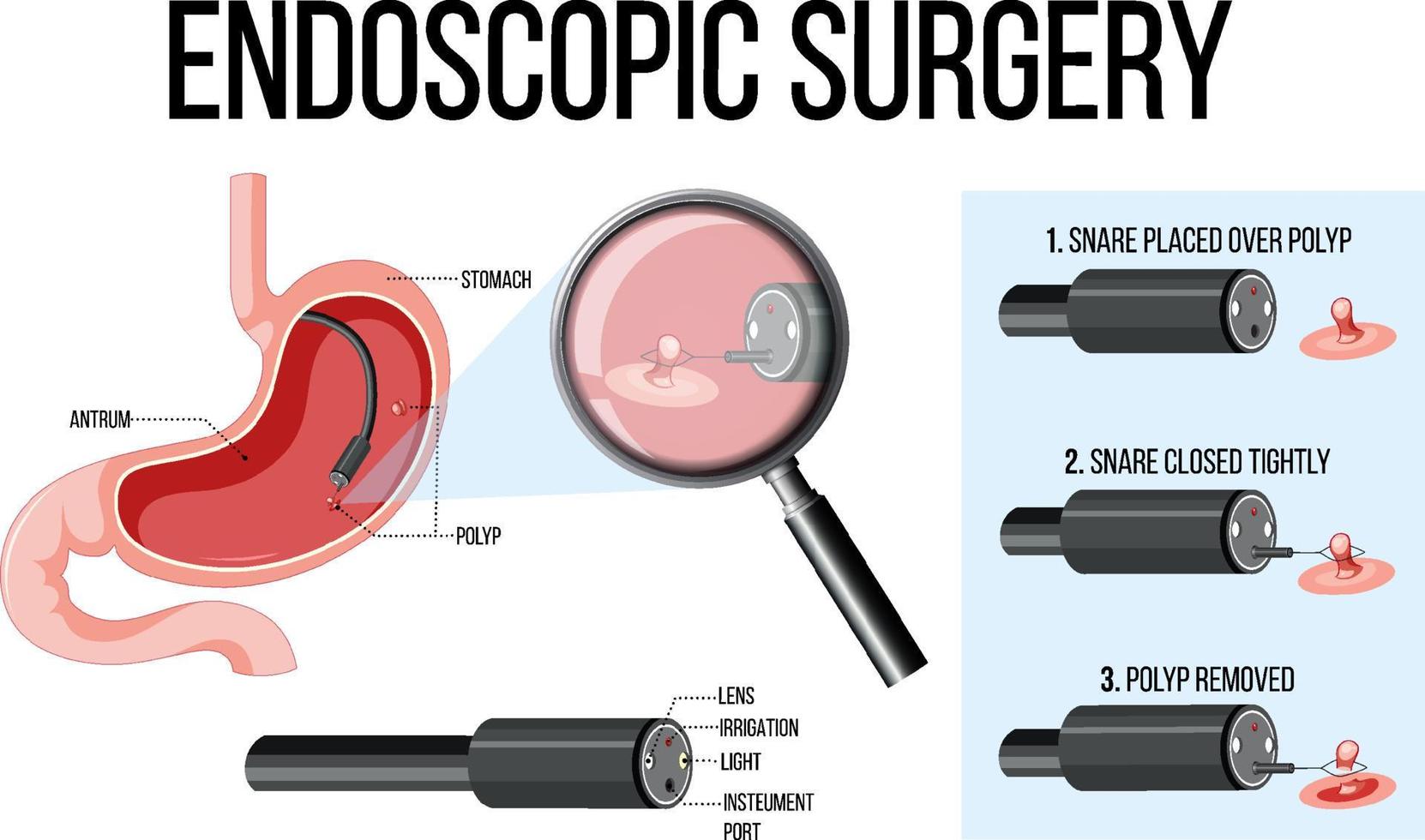 diagrama que muestra la cirugía endoscópica vector