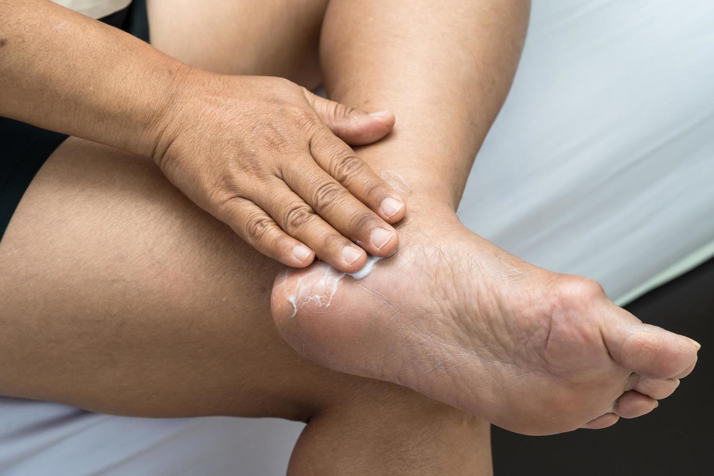 Woman care feet with cracked and dry heel skin cream at home. photo
