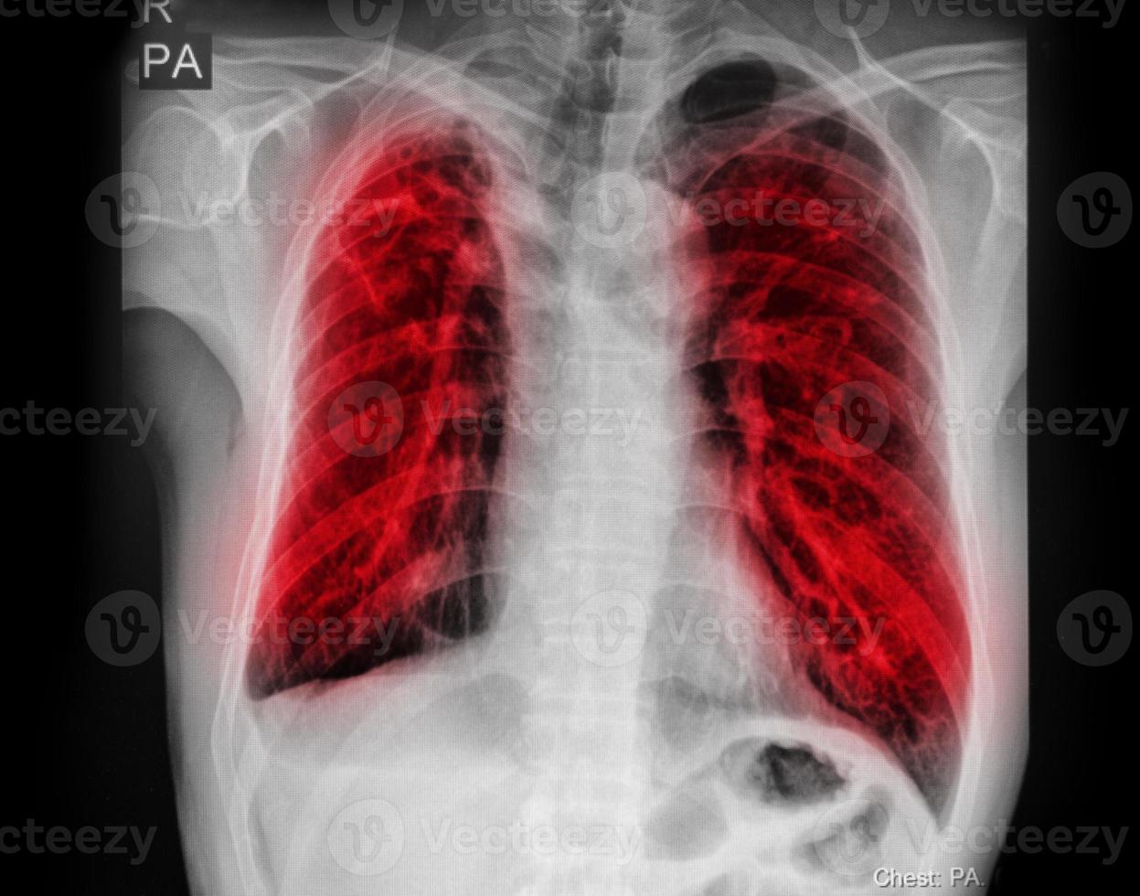 Pulmonary Tuberculosis  TB  Chest x-ray show alveolar infiltration at both lung due to mycobacterium tuberculosis infection. photo