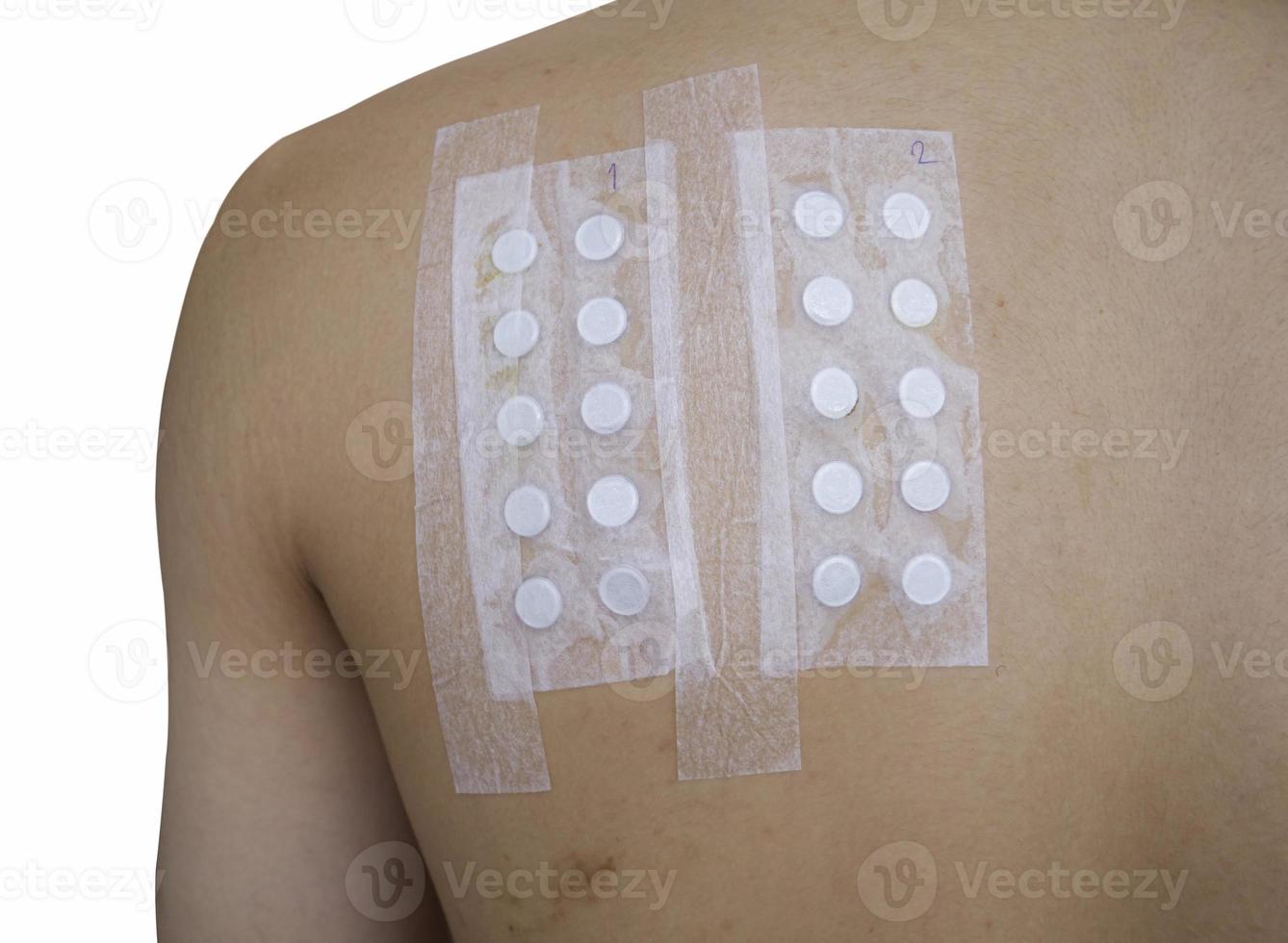 Applying Patch Test to test for chronic allergic rash from chemical exposure through skin. Skin allergy test strips. photo