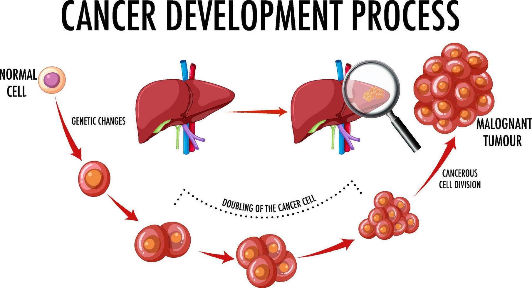 diagrama que muestra el proceso de desarrollo del cáncer vector