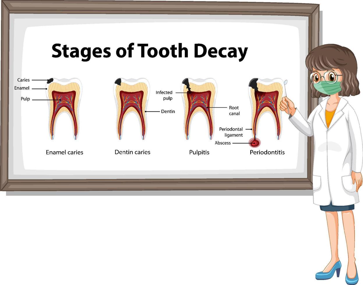 infografía de humanos en las etapas de la caries dental vector