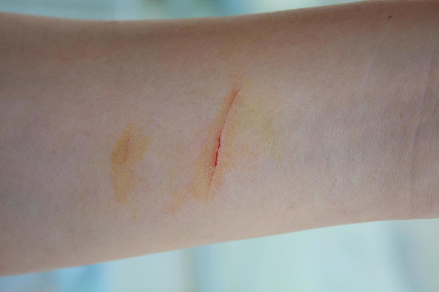 scratched wound on arm photo