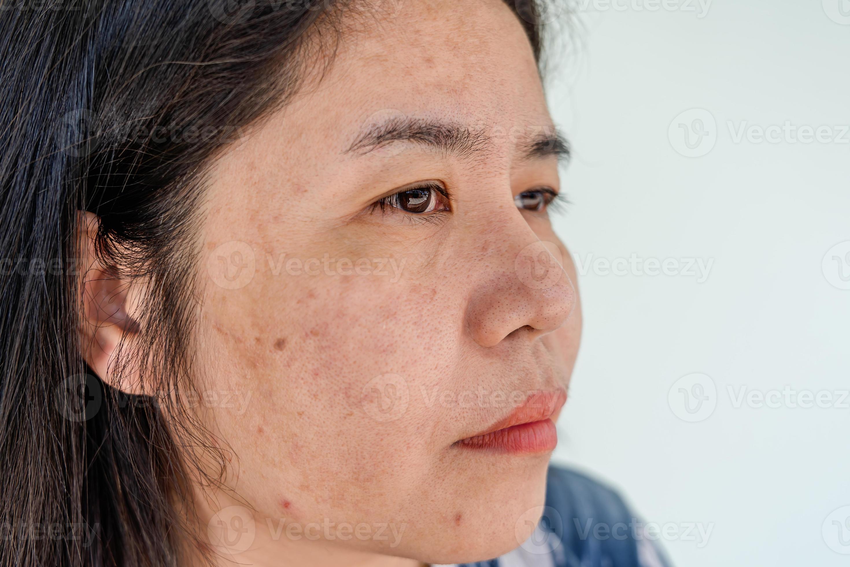 Big Blackhead Pimple - jxnpejz
