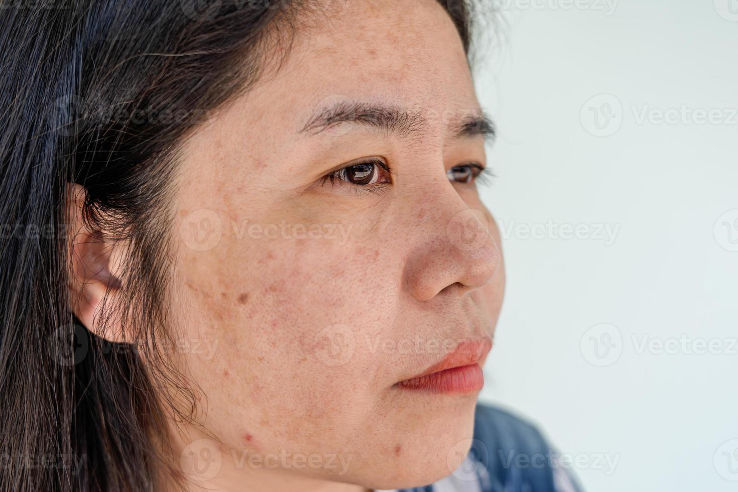 Close up of Asian adult woman face has freckles, large pores, blackhead pimple and scars problem from not take care for a long time. Soft focus of skin problem face. Treatment and Skincare concept photo