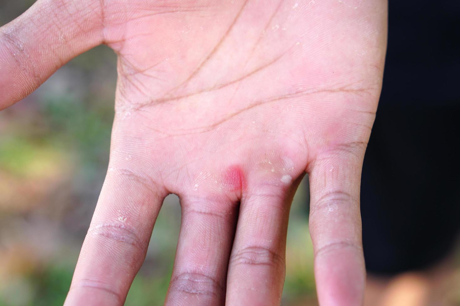 human hand is blistered and inflamed due to heavy use. photo