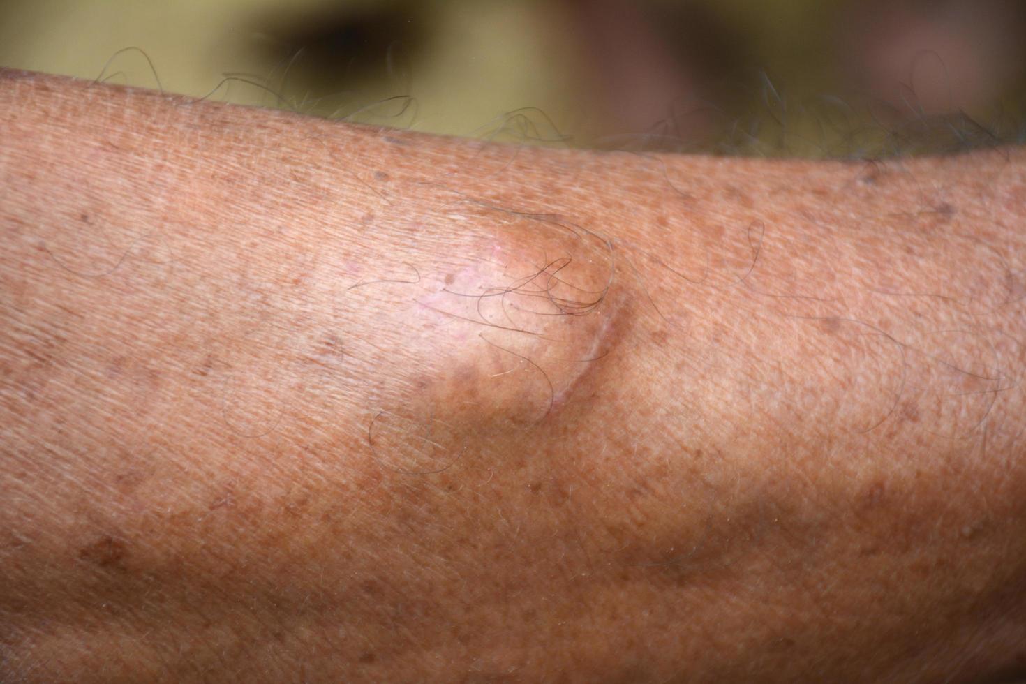 An old person's skin is abnormally raised. photo