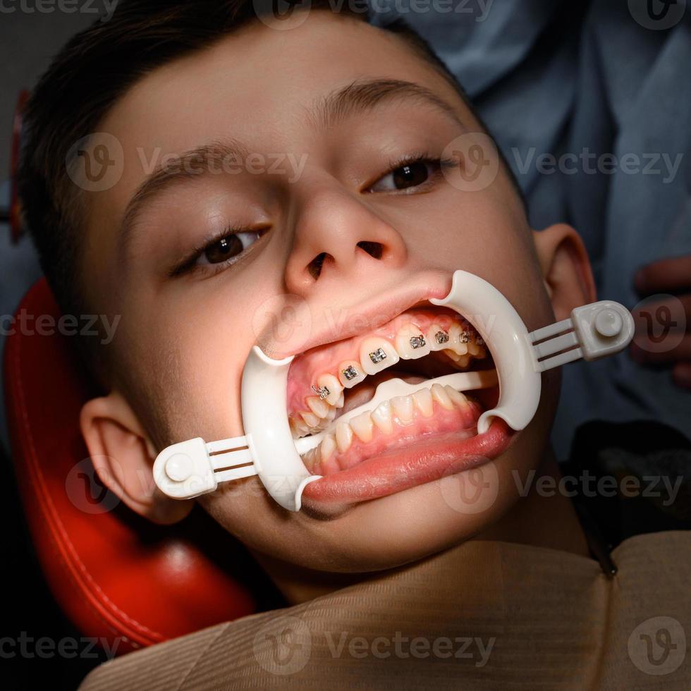 retractor blanco en los labios e instalación de aparatos metálicos en los dientes superiores del adolescente. foto