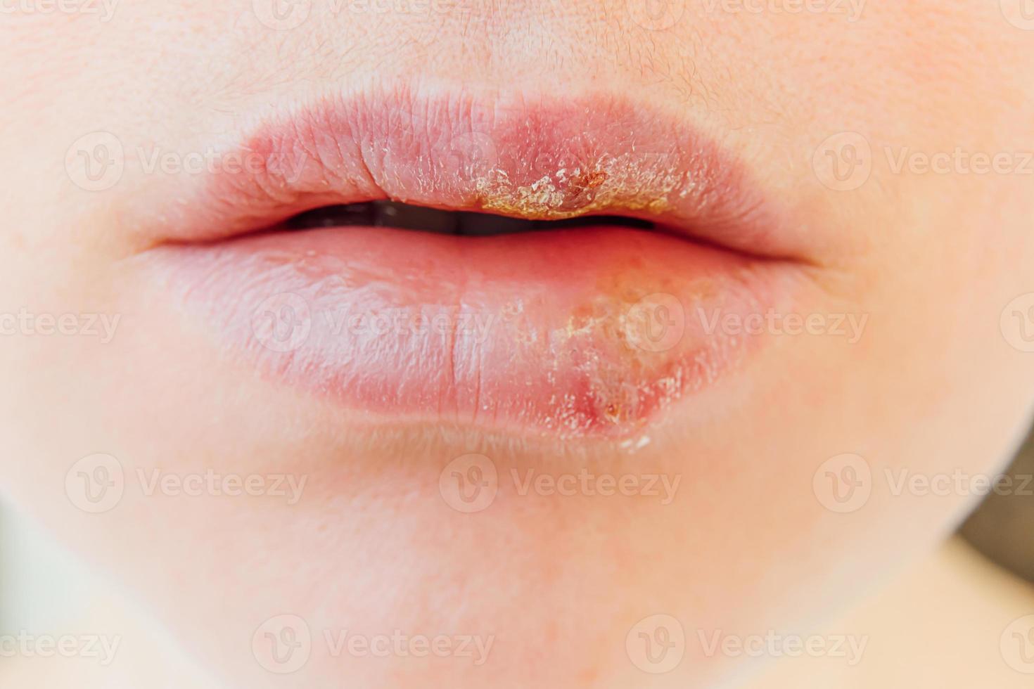 Close up of girl lips affected by herpes. Treatment of herpes infection and virus. Part of young woman face, lips with herpes affected. Beauty dermatology concept. photo