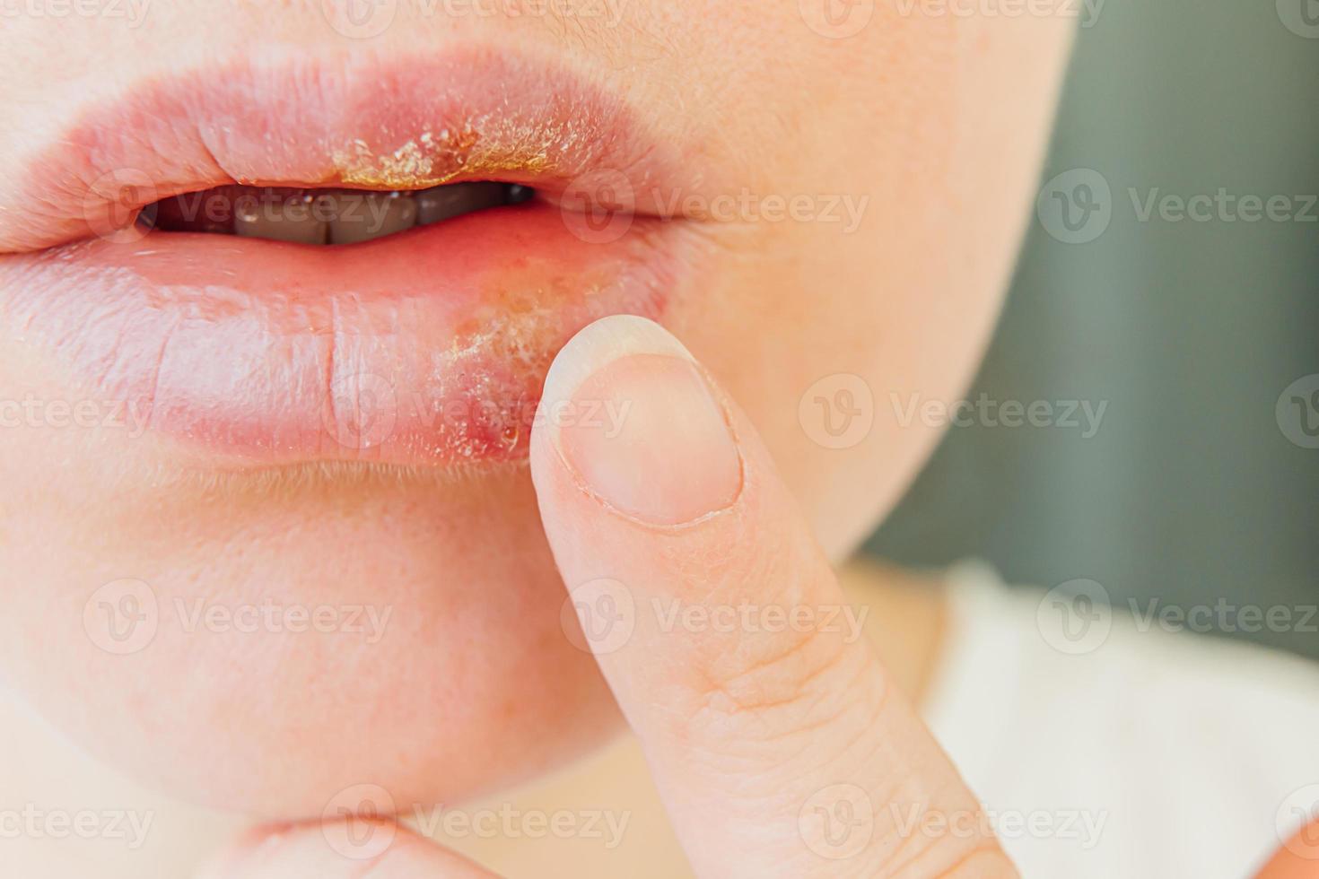 Close up of girl lips affected by herpes. Treatment of herpes infection and virus. Part of young woman face with finger touching pain on lips with herpes affected. Beauty dermatology concept. photo