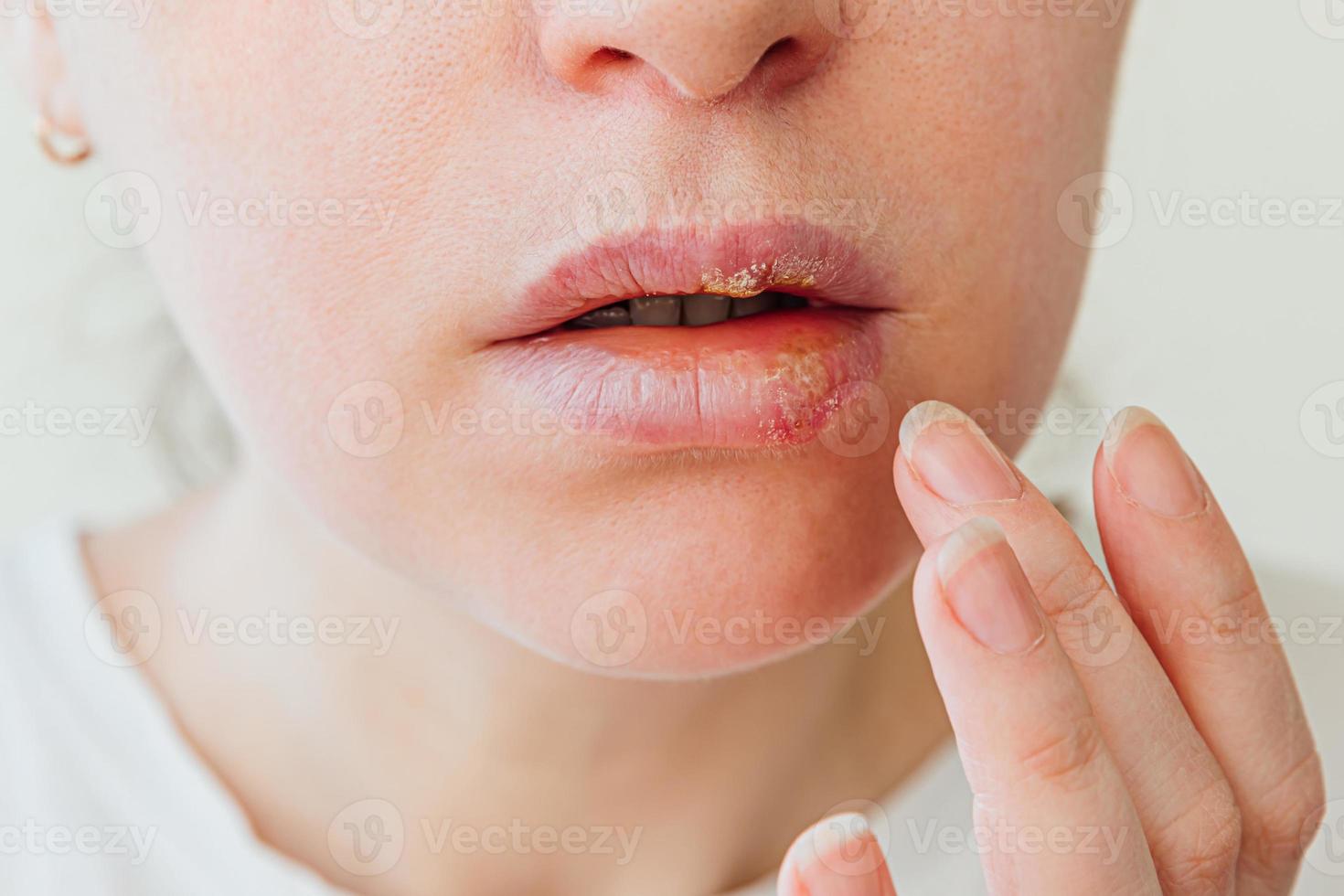 Close up of girl lips affected by herpes. Treatment of herpes infection and virus. Part of young woman face with finger touching pain on lips with herpes affected. Beauty dermatology concept. photo