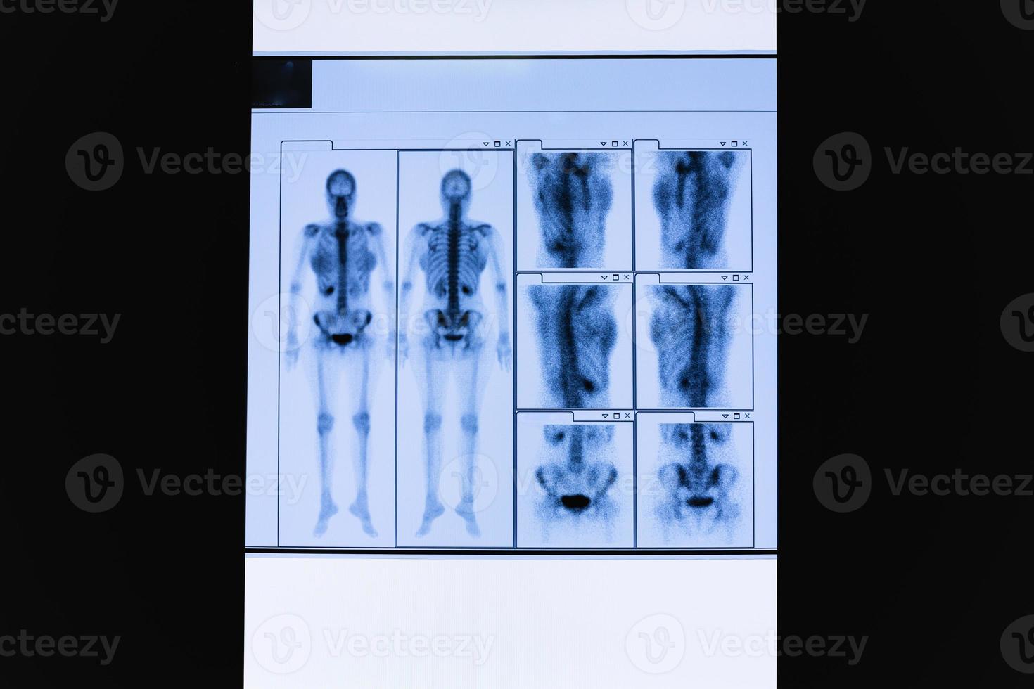 conjunto de tomografía computarizada del esqueleto de cuerpo entero femenino y órganos internos. foto