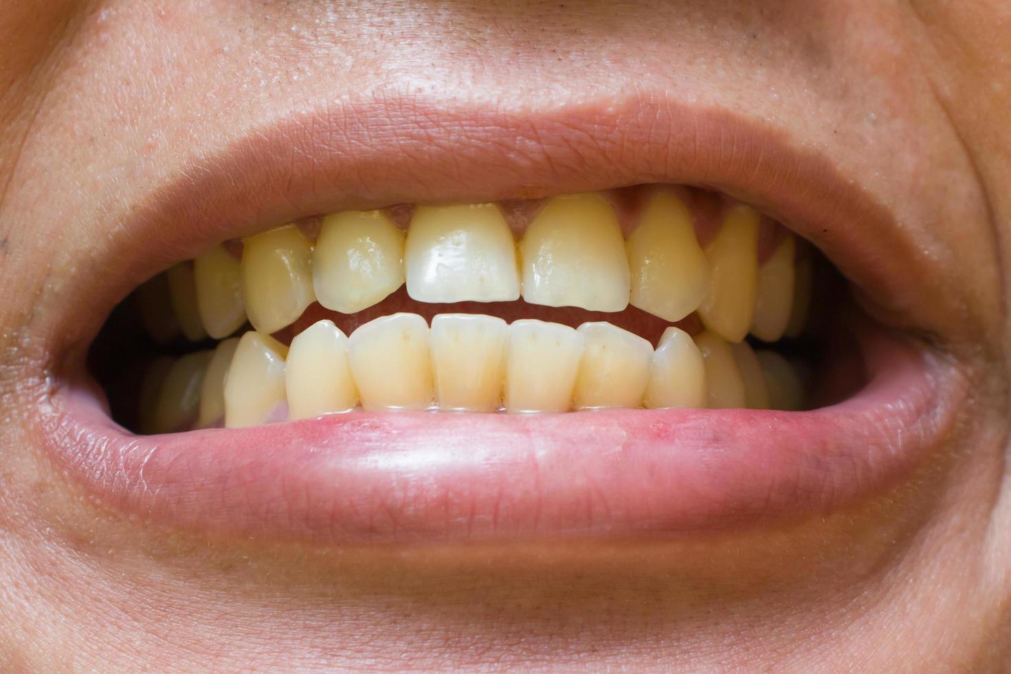 los dientes de un hombre son amarillos foto