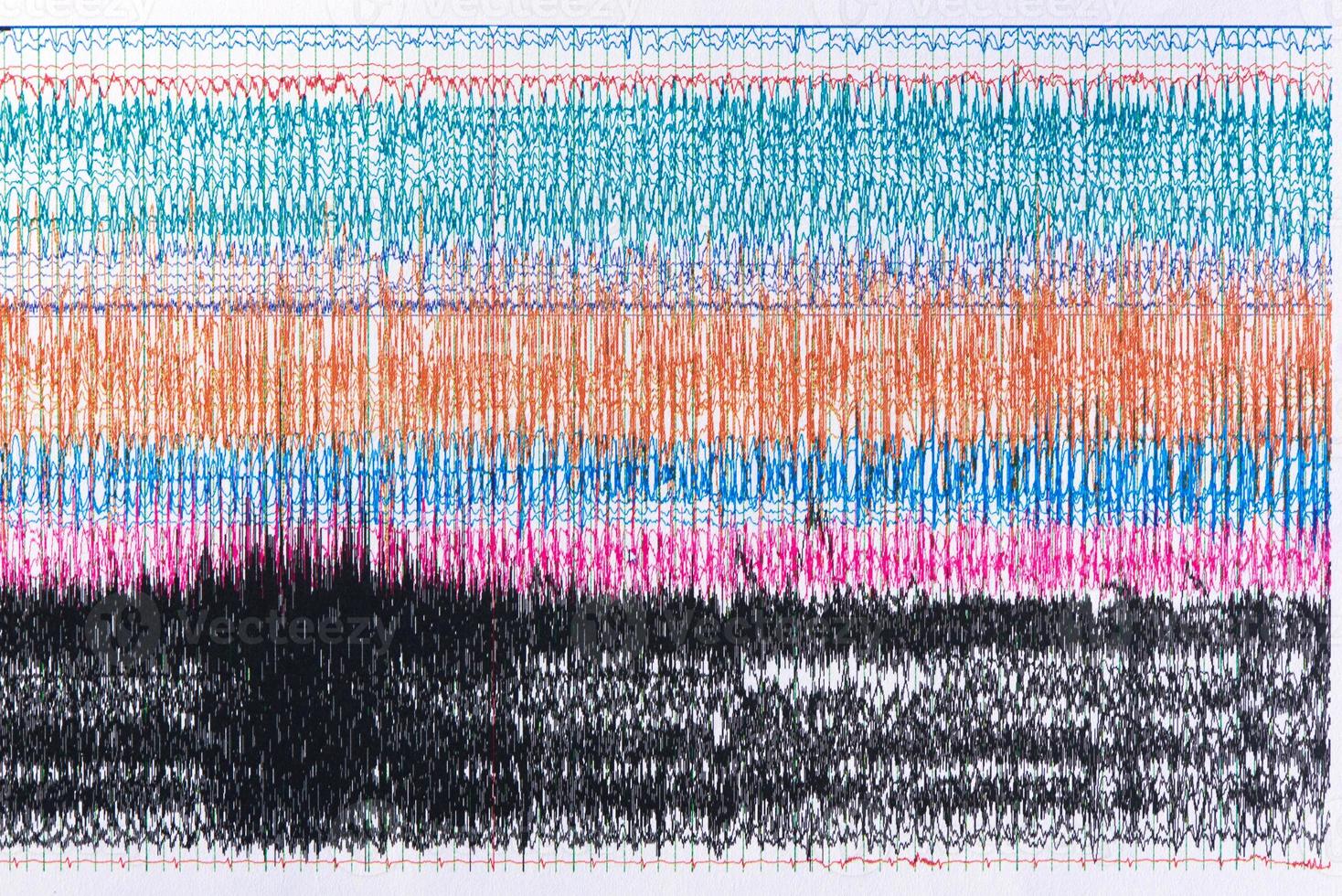 fotografía de ondas cerebrales durante una convulsión. foto