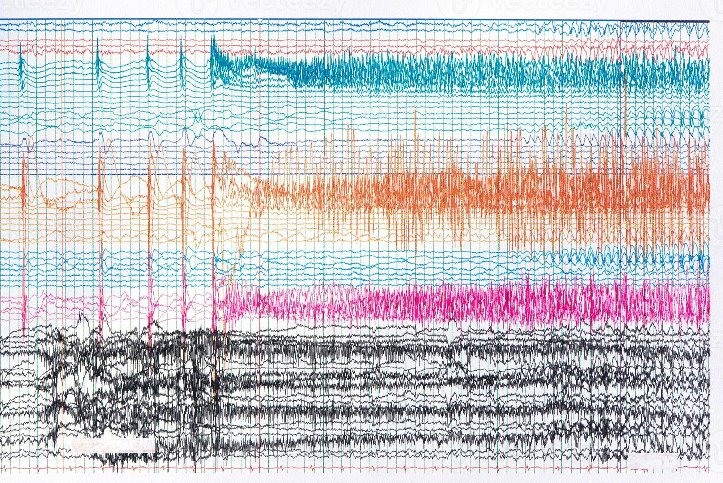 Photograph of ictal EEG during seizure photo