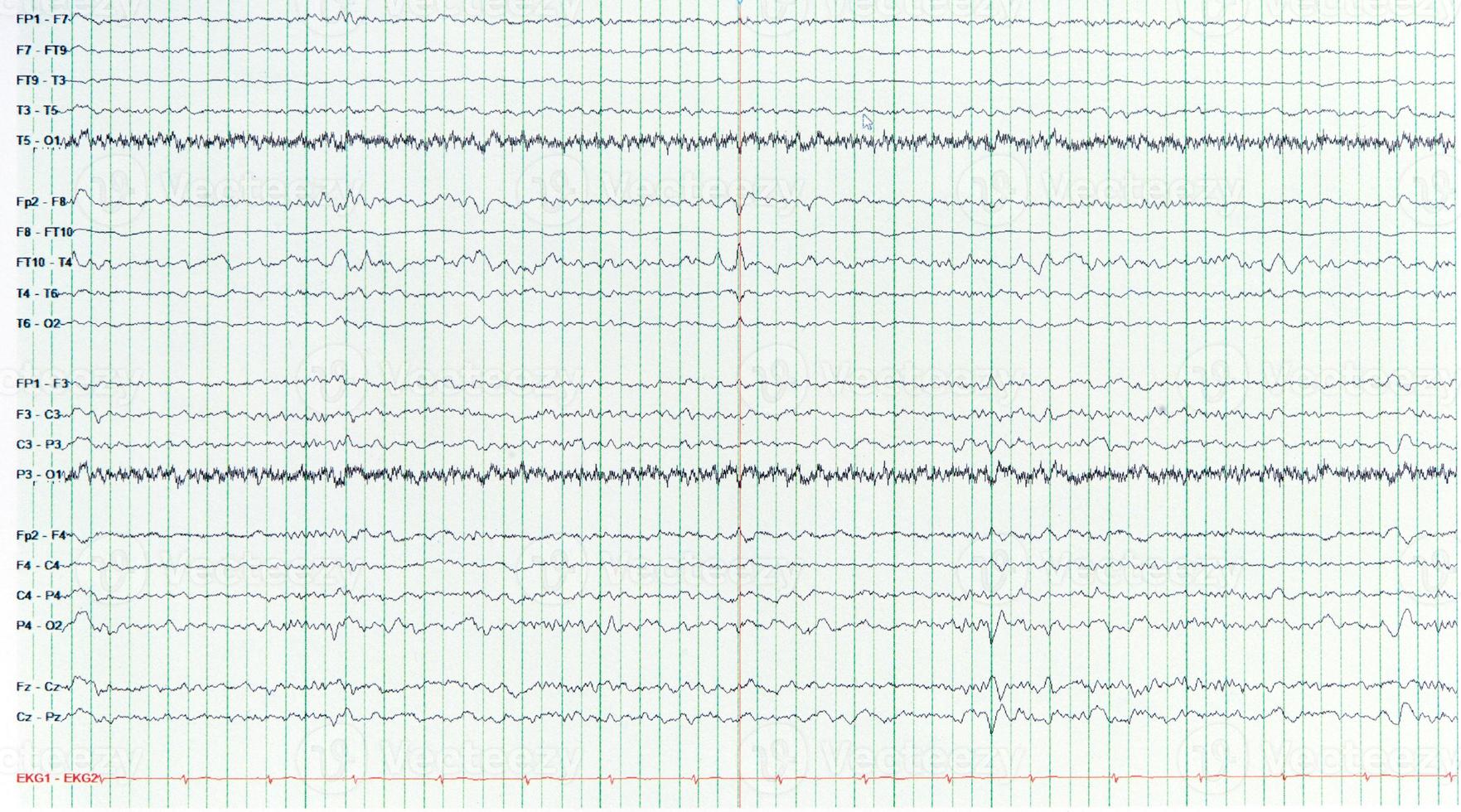 Photography of sharp wave during interictal EEG in epilepsy photo