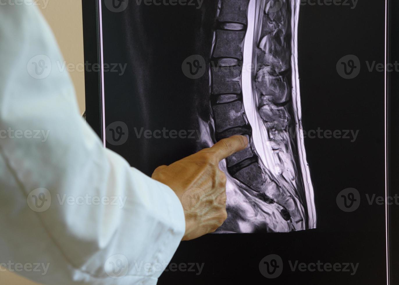 médico apuntando a la resonancia magnética de la columna lumbar foto