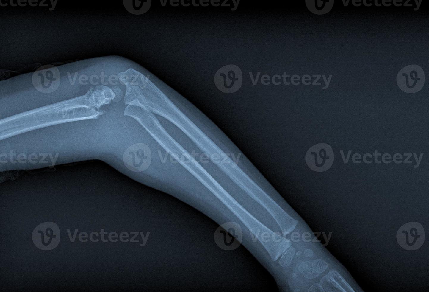 radiografía de brazo roto foto