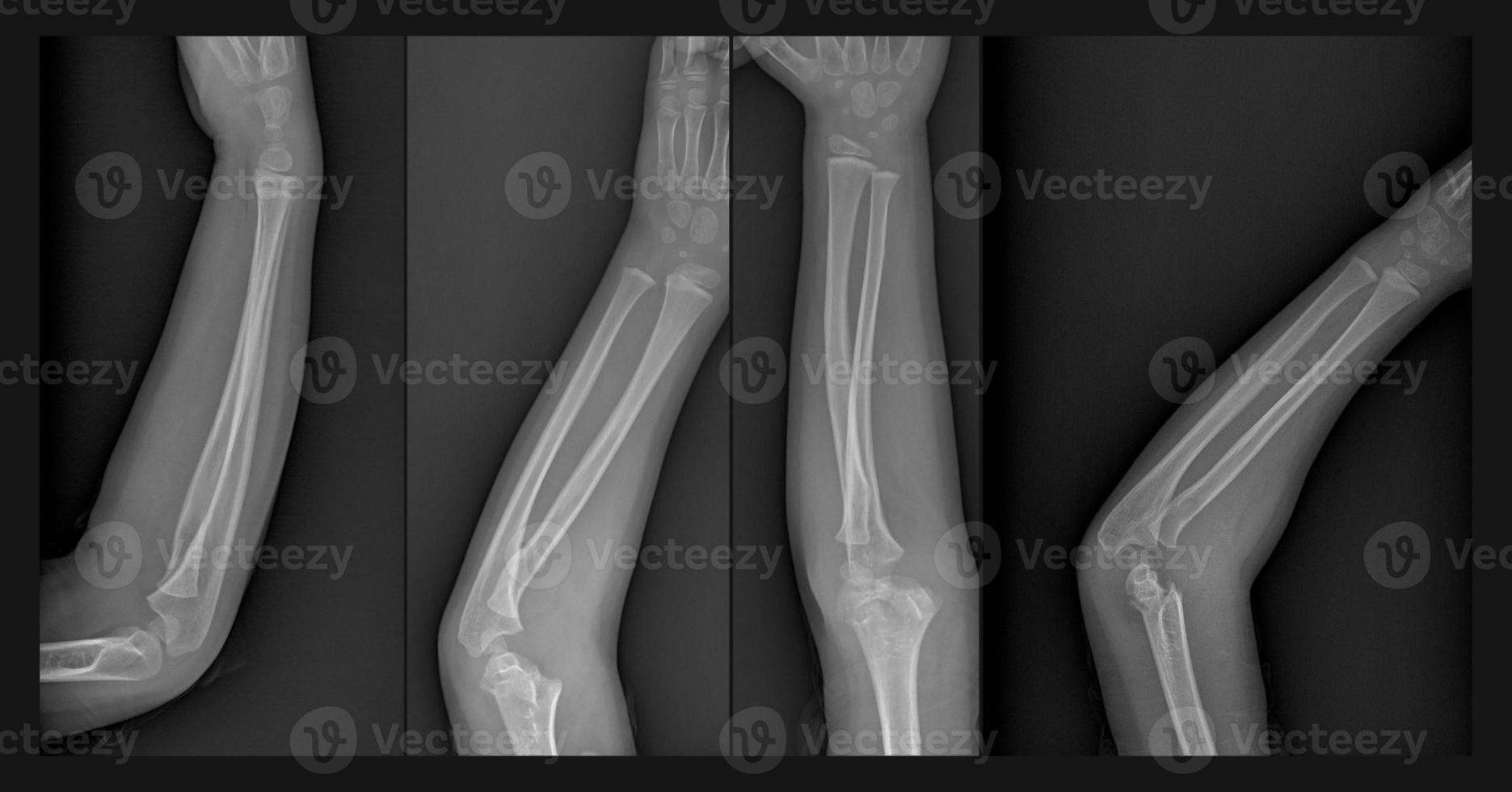 Broken arm xray 7331053 Stock Photo at Vecteezy