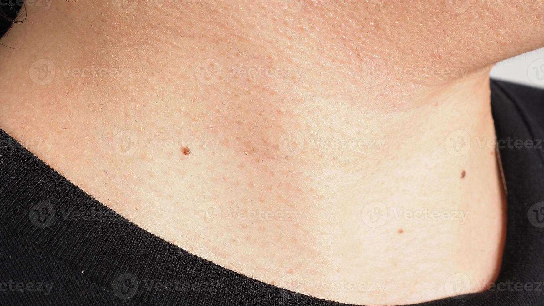 Wart skin removal. Macro shot of warts near eye on face. photo